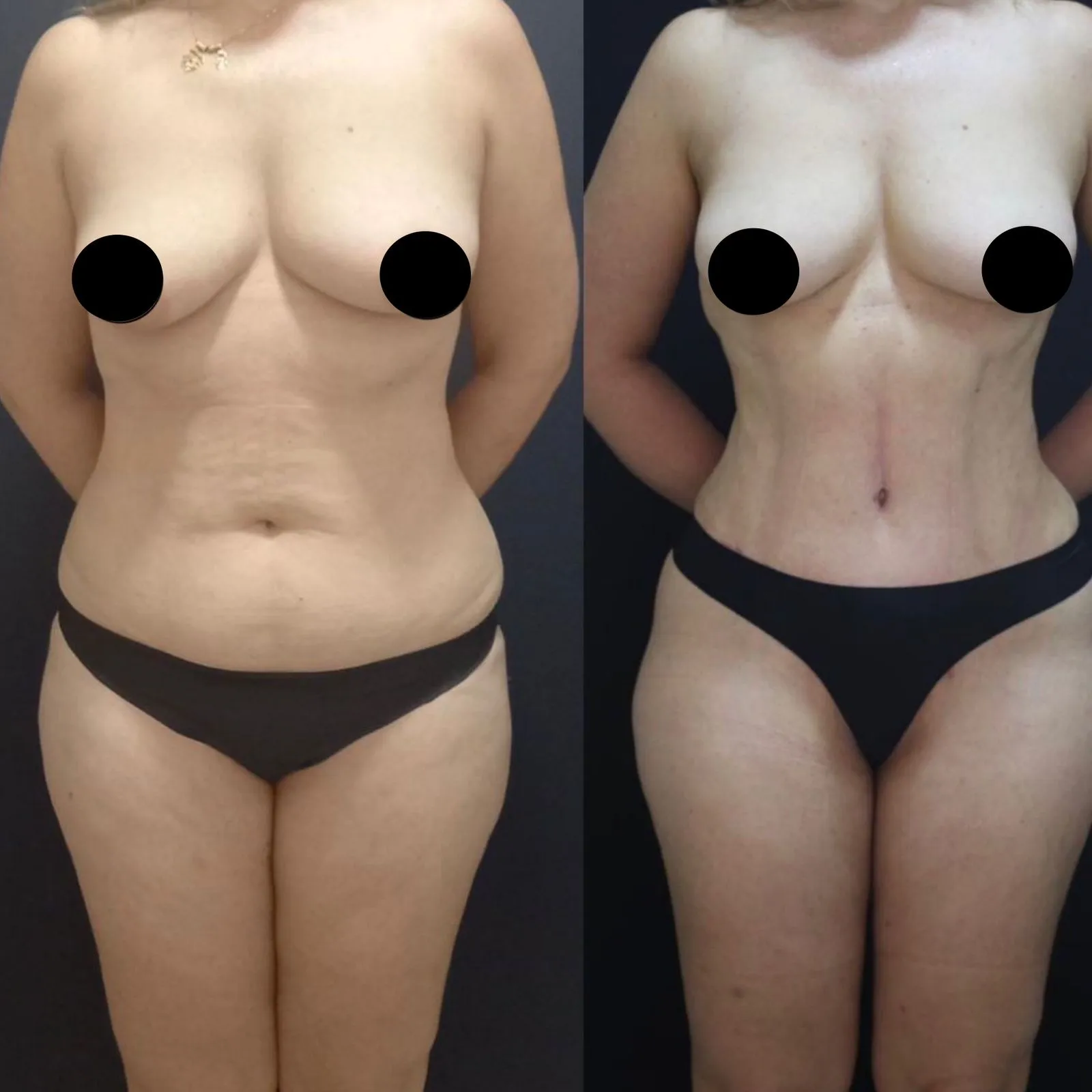 Abdominoplastia - Cirurgia Plástica