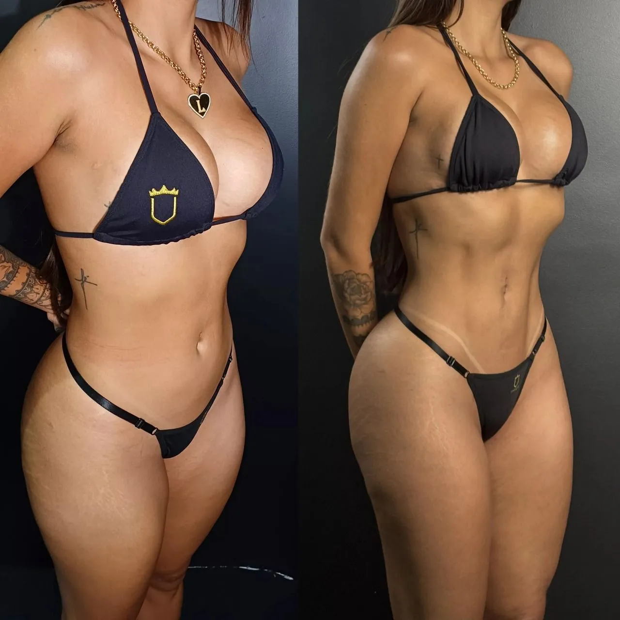 Lipoaspiração - Procedimento Estético