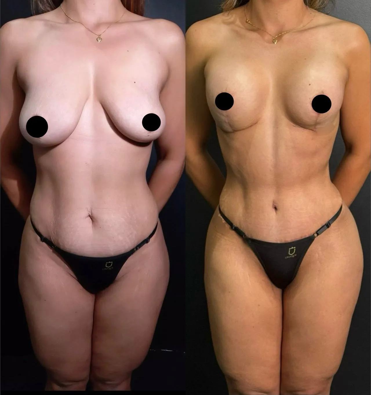 Mommy Makeover - Transformação Pós-Maternidade